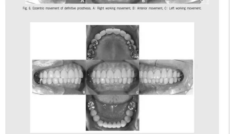 Fig. 7. Post-treatment  intra  oral  view.  A:  Maxillary  occlusal  view,  B:  Right  lateral  view,  C:  Frontal  view,  D:  Left  lateral  view,  E: