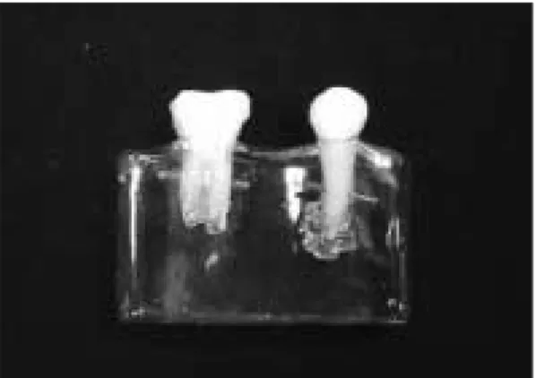Fig. 3. Design of GroupⅠ. Fig. 4. Diagram of tooth preparation of GroupⅡ.
