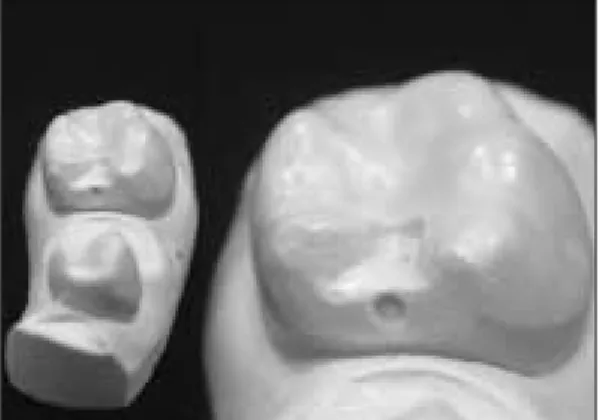 Fig. 11. Tin foil that was flattened. Fig. 12. Wax-up of  GroupⅢ.