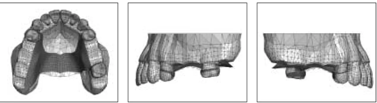 Fig. 2. Framework of removable partial denture.