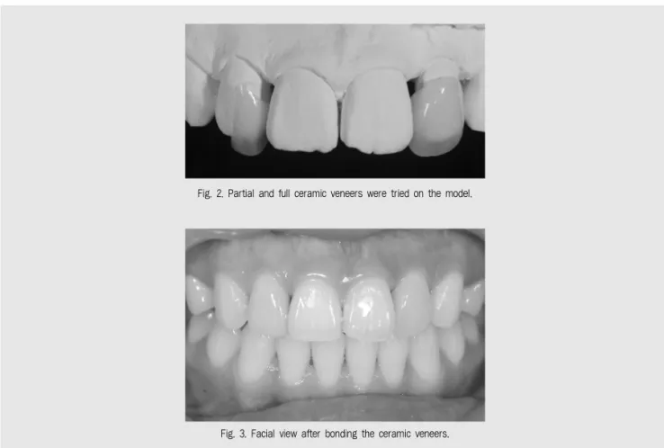 Fig. 2. Partial and full ceramic veneers were tried on the model.
