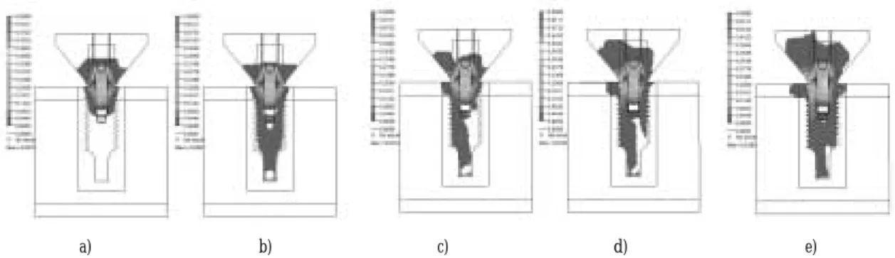 Fig. 5. The von Mises stress of bone with and without platform switching.