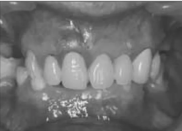 Fig. 3. Pattern resin model for test 1 Fig. 4. Rubber model of teeth for test 2