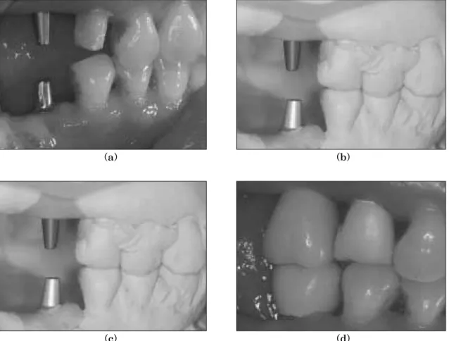 Fig. 10. Fabrication process of implant prosthesis using solid abutment of ITI implant system