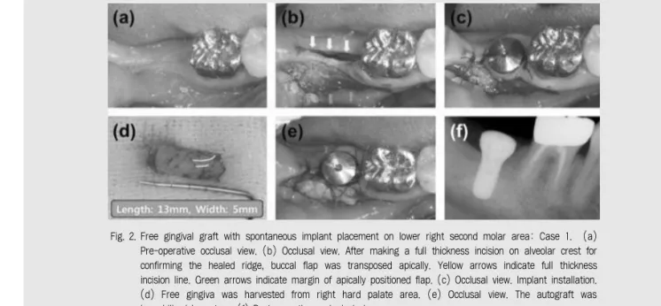 Fig. 2. Free gingival graft with spontaneous implant placement on lower right second molar area: Case 1