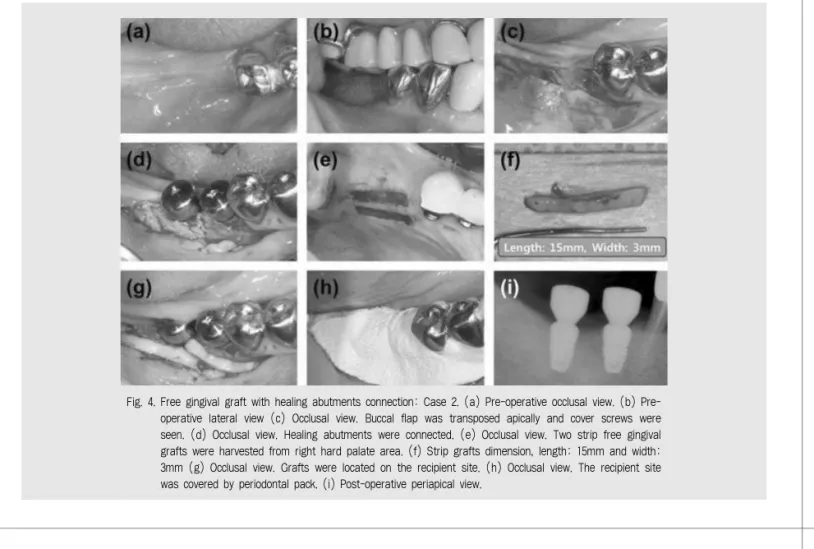 Fig. 3. Implant placement on lower right first and second molar area with autogenous bone graft: Case 2.