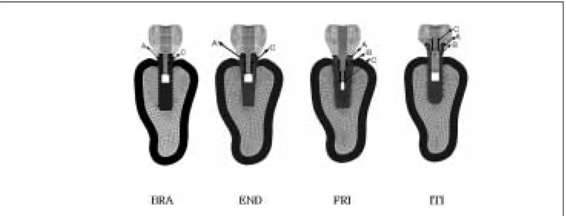 Fig. 2. Gap boundary of each model are shown in strong black line and each  finite element mod- mod-el  uses  Branemark(BRA),  Endopore(END),  Frialit-2(FRI),  I.T.I(ITI)  system  for  implant fixture, respectively