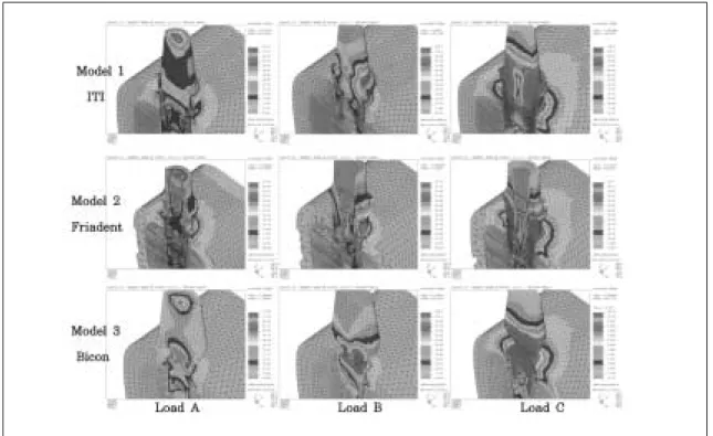 Fig. 7. The stress contours of model without crown uncer loading condition A, B, C.