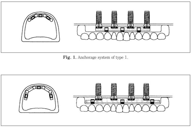 Fig. 2. Anchorage system of type 2.