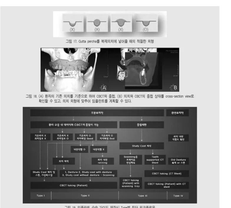 그림 18. (A) 환자의 기존 의치를 기준으로 하여 CBCT와 중첩, (B) 의치와 CBCT의 중첩 상태를 cross-section view로 확인할 수 있고, 의치 외형에 맞추어 임플란트를 계획할 수 있다.