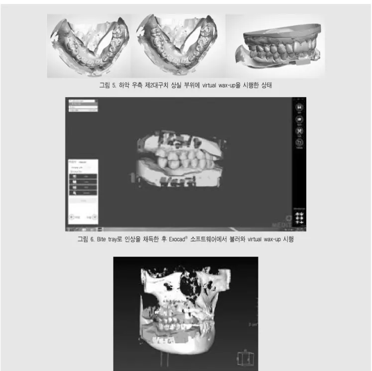 그림 6. Bite tray로 인상을 채득한 후 Exocad 소프트웨어에서 불러와 virtual wax-up 시행