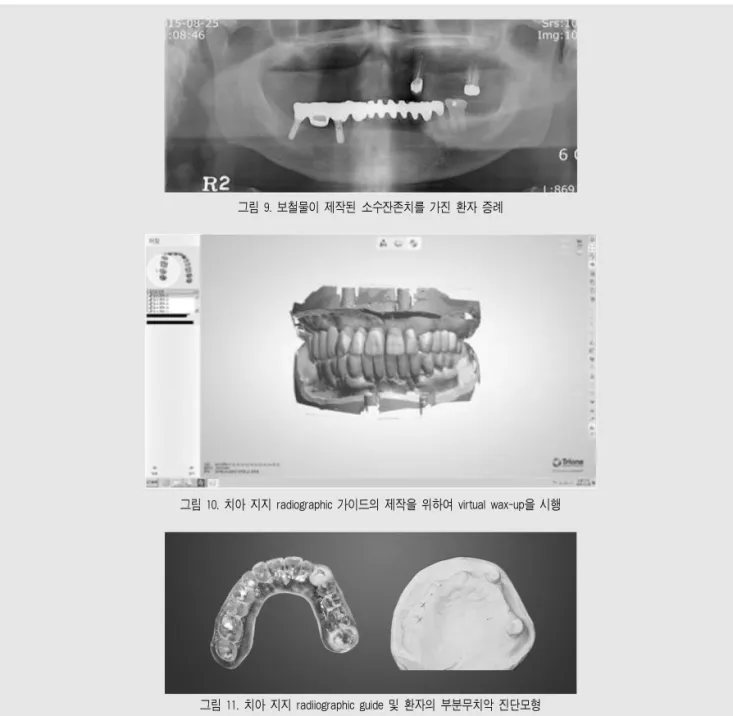 그림 10. 치아 지지 radiographic 가이드의 제작을 위하여 virtual wax-up을 시행