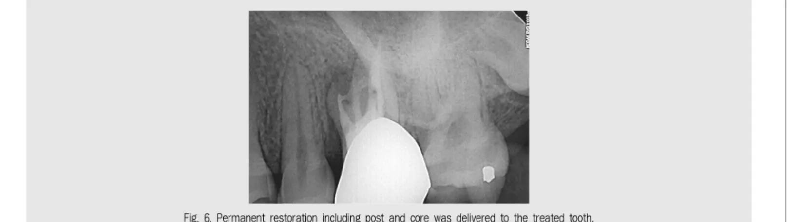 Fig. 6. Permanent restoration including post and core was delivered to the treated tooth.