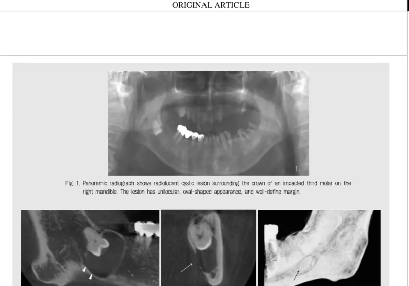 Fig. 2. A, B, C Parapanoramic, cross-sectional, and 3D cone-beam computed tomographic images show thinning and partial discontinuity of lingual cortex suspected as perforation(arrow)