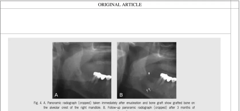Fig. 4. A. Panoramic radiograph (cropped) taken immediately after enucleation and bone graft show grafted bone on the  alveolar  crest  of  the  right  mandible