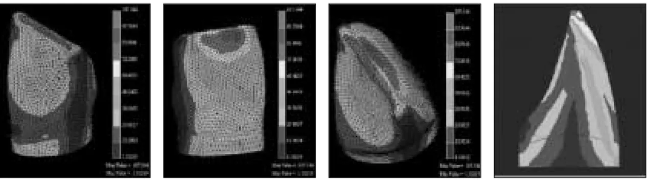 Fig. 11. Metal die ; 0.5mm chamfer finish line.   
