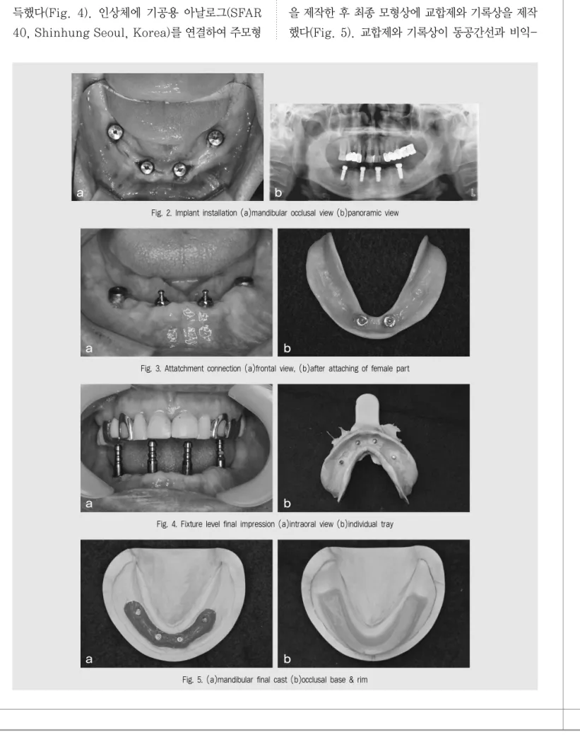 Fig. 2. Implant installation (a)mandibular occlusal view (b)panoramic view