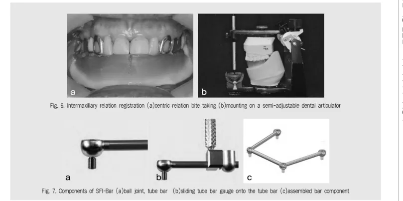 Fig. 6. Intermaxillary relation registration (a)centric relation bite taking (b)mounting on a semi-adjustable dental articulator  