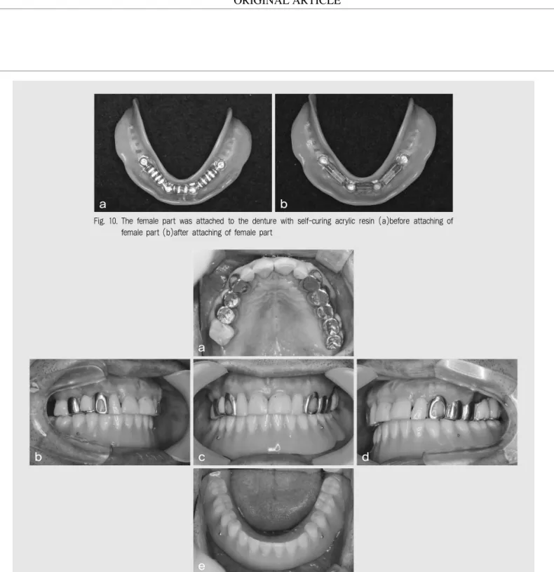 Fig. 10. The female part was attached to the denture with self-curing acrylic resin (a)before attaching of female part (b)after attaching of female part