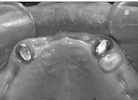 Fig. 11. Master model of coping. Fig. 12. Copings were cemented in the mouth.