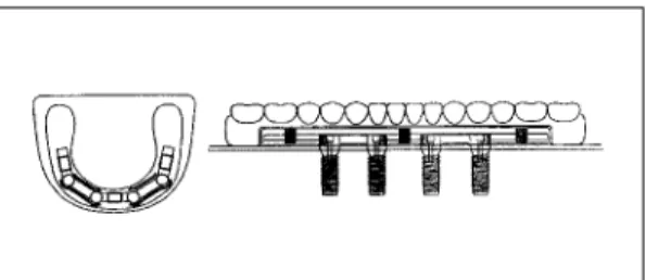 Fig. 5. Anchorage system of type 5. Fig. 6. Prosthetic design of type 6.