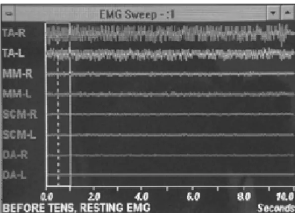Fig. 2. The electromyographic activity during rest Fig. 3. The electromyographic activity during clench- clench-ing