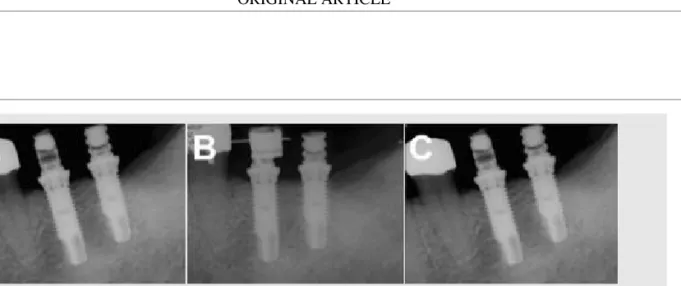 Fig. 8. Periapical radiographs on the area of the left mandibular first and second molars