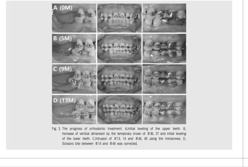 Fig. 3. The  progress  of  orthodontic  treatment.  A,Initial  leveling  of  the  upper  teeth