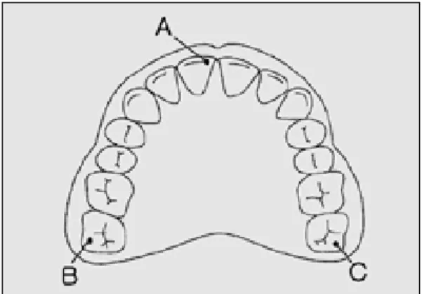 Fig. 5. Silicone mold for duplication of wax denture. Fig. 6. Positions of reference points on maxillary den- den-ture.