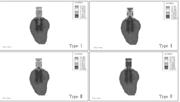 Fig. 21. von Mises stresses in load case 1. (bucco-lingual section)