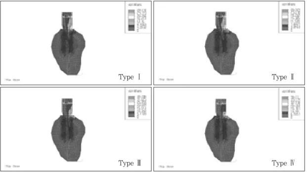 Fig. 24. von Mises stresses in load case 4. (bucco-lingual section)Type ⅠType Ⅲ Type ⅡType ⅣType ⅠType ⅢType ⅡType Ⅳ