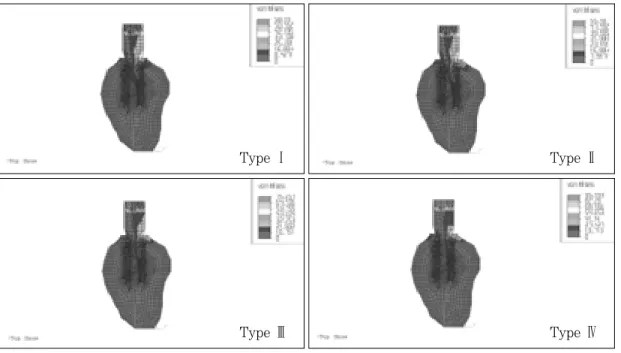 Fig. 25. von Mises stresses in load case 5. (bucco-lingual section)