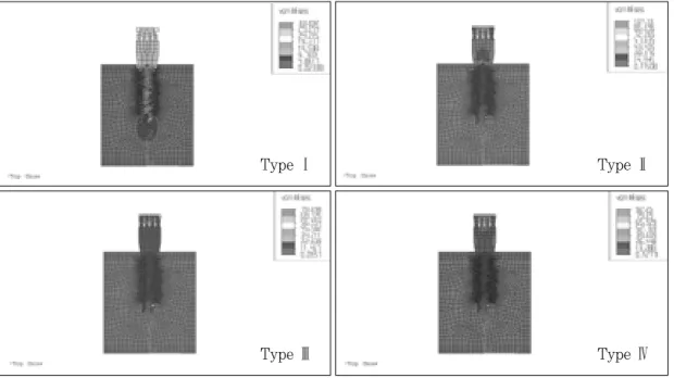 Fig. 29. von Mises stresses in load case 3. (mesio-distal section)Type Ⅰ
