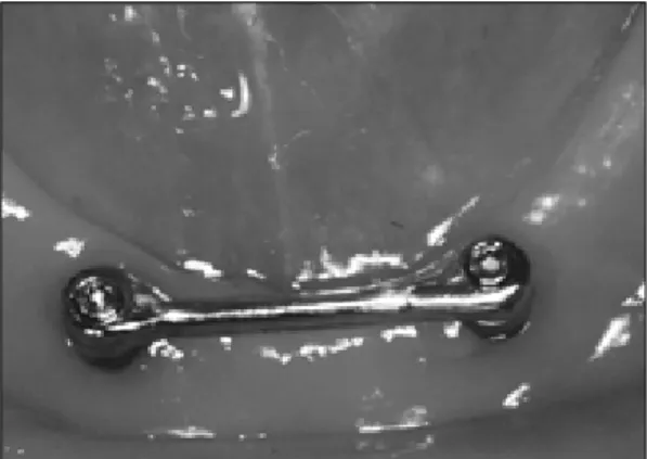 Fig. 14. Ant. view after denture delivery.
