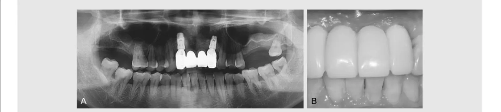 Fig. 6. Postoperative radiographic and clinical photographic. (A) Panoramic view, (B) Frontal view.