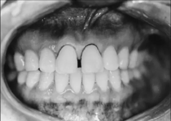 Fig. 1. Facial view of the patient’s condition. Fig. 2. Final preparation and impression taking