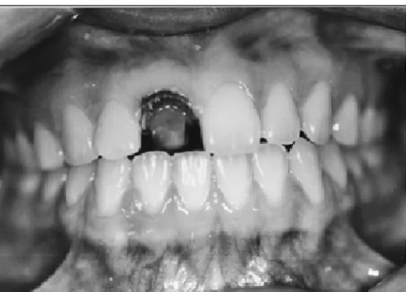Fig. 6. (a) Facial view of  Empress 2 crown after insertion and finishing (b) at  rest position.