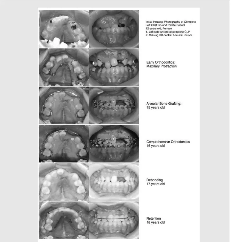 Fig. 5. Unilateral Left Complete Cleft lip and palate patient