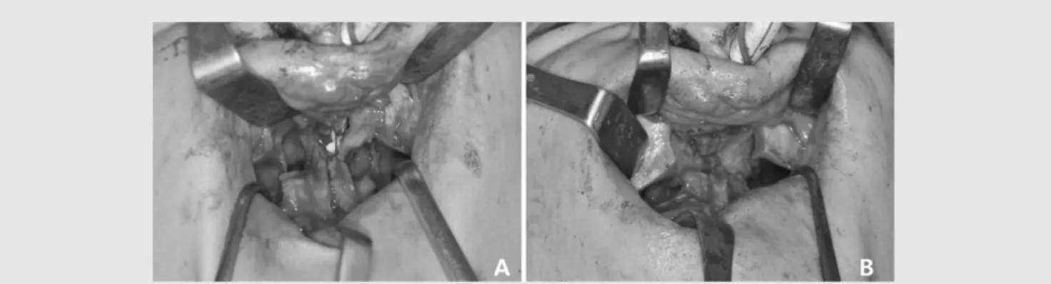 Fig. 2. Cleft palate가 동반된 환자의 경우 nasal floor를 maxilla로부터 periosteal elevator 로 들어올리기가 힘든 경우가 있으며 이 경우 sharp dissection을 해야하는 경우가 있다