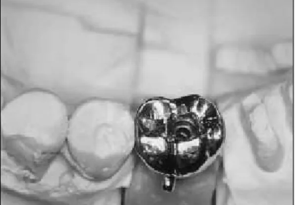 Fig. 1. retrievable crown is shown before cementa- cementa-tion to the abutment