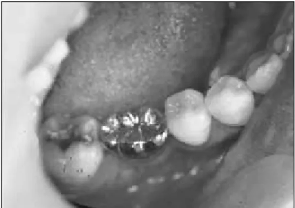 Fig. 4. access  cavity  of  cemented  restoration  is closed with resin