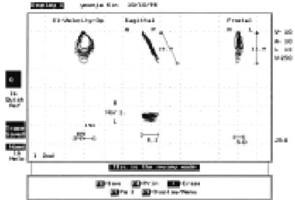 Fig. 21. Left side unilateral chewing of complete den- den-ture wearer who had good residual  alveolar ridge.