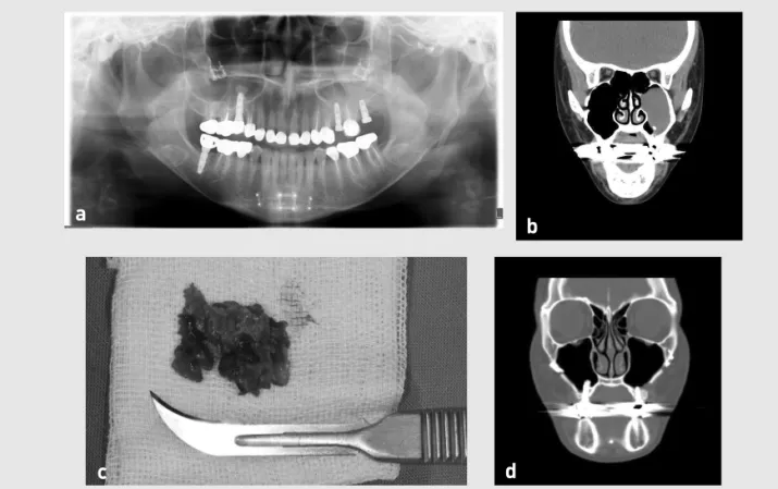 Fig. 1. The chronic symptomatic sinusitis occurred in the left maxillary sinus after sinus graft through transalveolar approach(a)