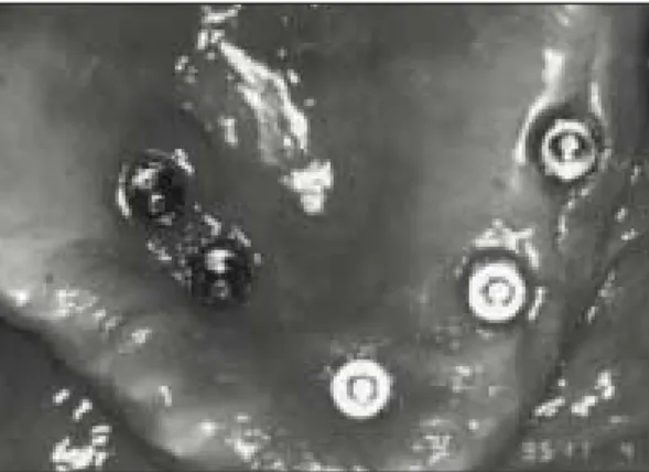 Fig.  6.  Postoperative  panoramic  radiograph  of case  3,  18  months  after  surgery