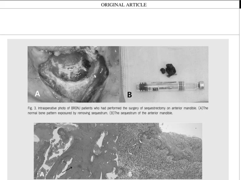Fig. 3. Intraoperative photo of BRONJ patients who had performed the surgery of sequestrectomy on anterior mandible