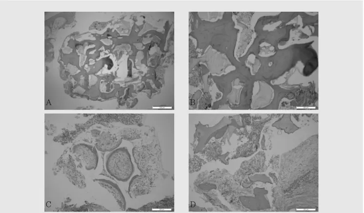 Fig. 2. a-d) 6개월 후 골이식부의 조직생검을 시행하였으며, 양호한 신생골 형성이 관찰된다.ABCD Fig. 3. a) 좌측 제2소구치의 임플란트가 육아조직으로 인한 골유착 실패가 관찰된다