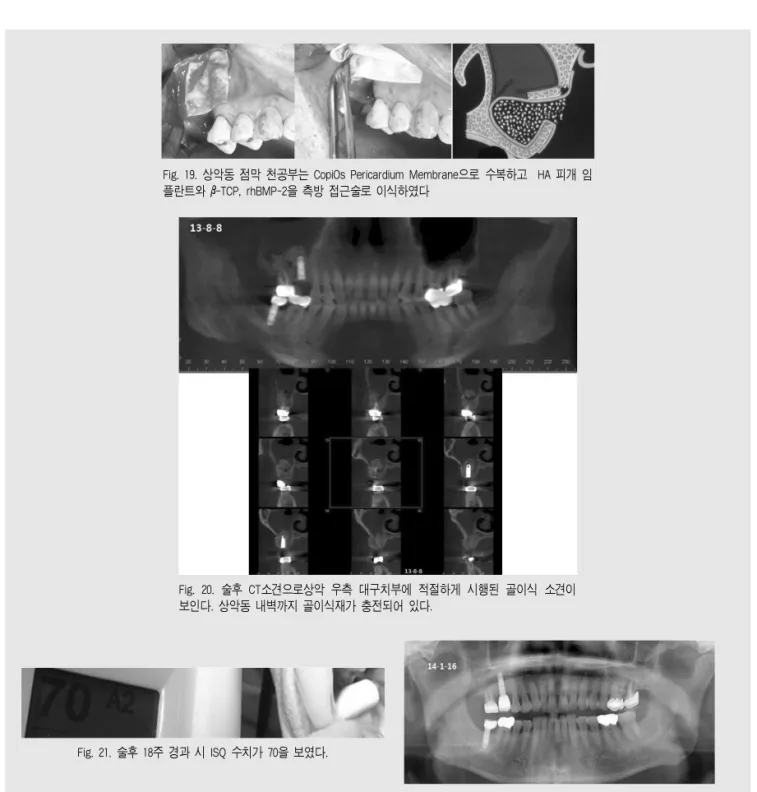 Fig. 19. 상악동 점막 천공부는 CopiOs Pericardium Membrane으로 수복하고 HA 피개 임 플란트와 β-TCP, rhBMP-2을 측방 접근술로 이식하였다
