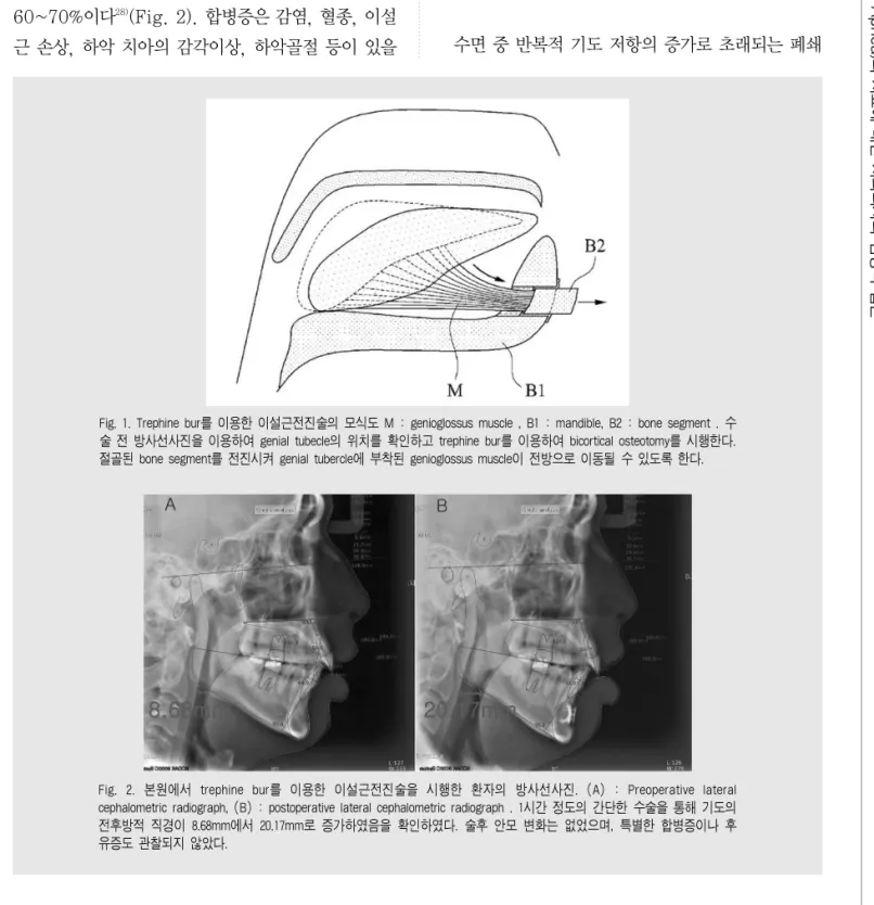 Fig. 1. Trephine bur를 이용한 이설근전진술의 모식도 M : genioglossus muscle , B1 : mandible, B2 : bone segment 