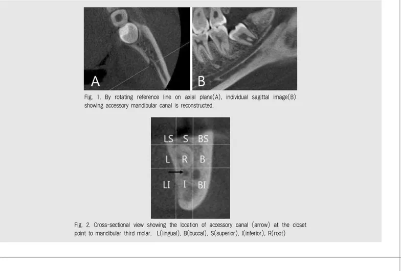 Fig.  2.  Cross-sectional  view  showing  the  location  of  accessory  canal  (arrow)  at  the  closet point to mandibular third molar