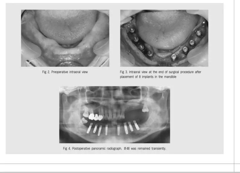 Fig 4. Postoperative panoramic radiograph. #48 was remained transiently.
